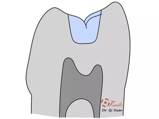 谭建国—后牙牙体缺损修复方案选择