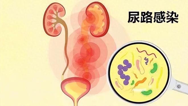50%女性一生至少经历一次尿路感染，出现4类症状，及时就医