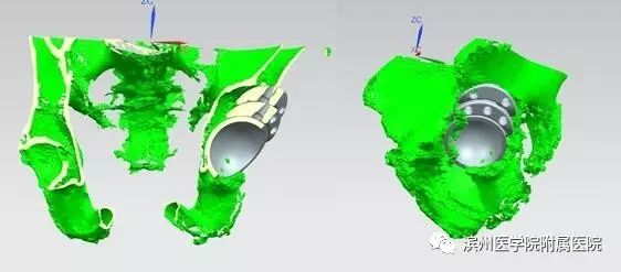「滨医附院•技术」3D打印技术辅助为93岁高龄患者精准实施人工全髋关节翻修手术！