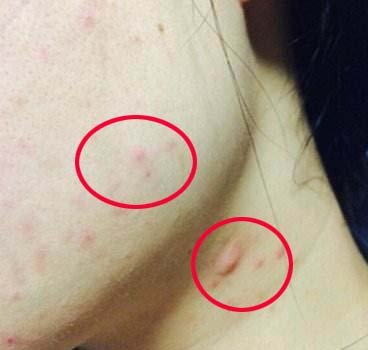 真人体验光子嫩肤！告诉你这上千元花得值不值
